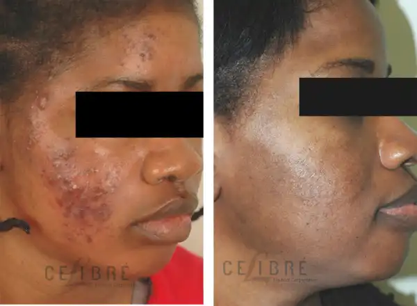 4 Ways To Get Rid Of Dark Spots On The Face!