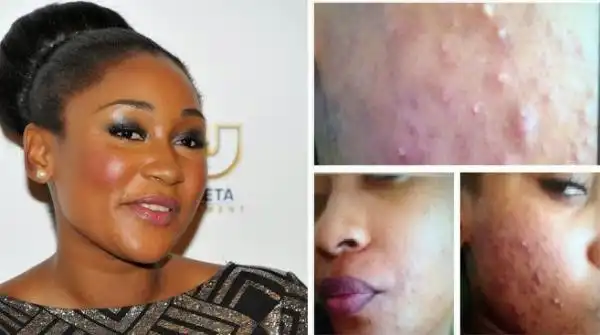 Photo: How I Cured My Horrible Acne - Mbong Amata