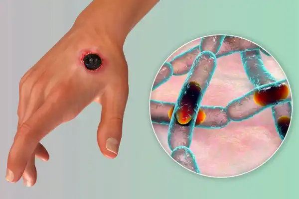 FG begins free anthrax vaccination in Niger