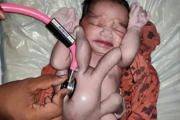 Unbelievable! Check Out Photos Of The Baby Who Was Born With Four Arms And Four Legs