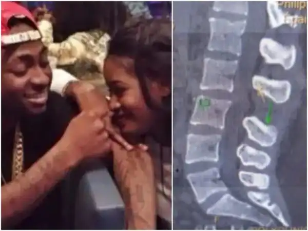 Davido’s Ex-lover, Sira Kante Fractures Spine In Terrible Auto Crash (Photos)
