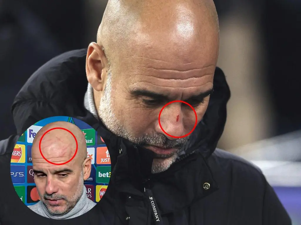 UCL: I want to hurt myself – Guardiola speaks on scratches on his nose, face