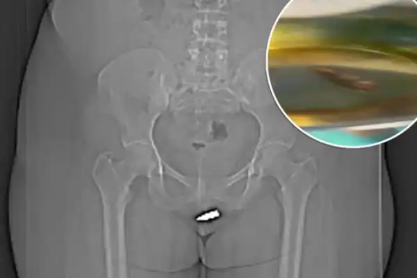 Stray Bullet Hits Women In Her Private Part While Inside Her Living Room