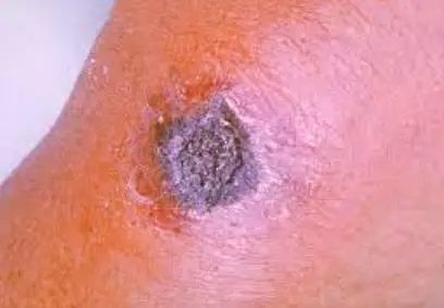 Anthrax: Stop possible outbreak with preventive measures, FG tells butchers