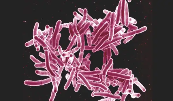 Govt must tackle poverty to end tuberculosis – Expert