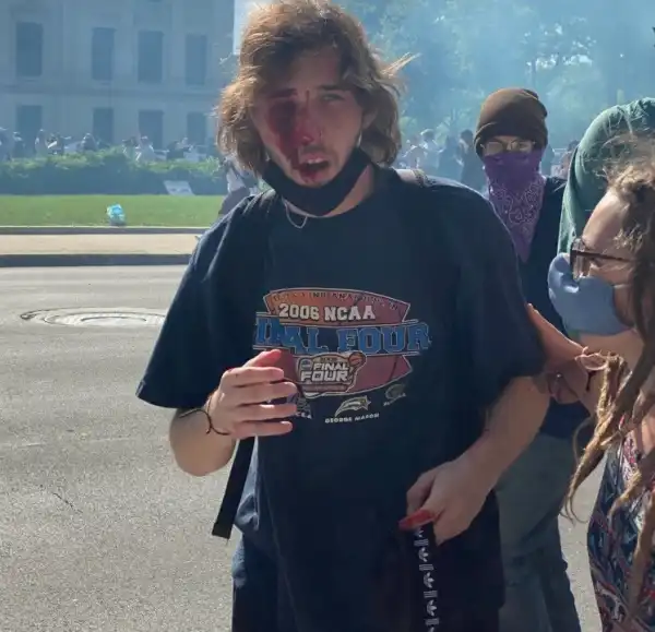 Man injured by police during George Floyd protest reveals he has lost one eye after surgery (photos)