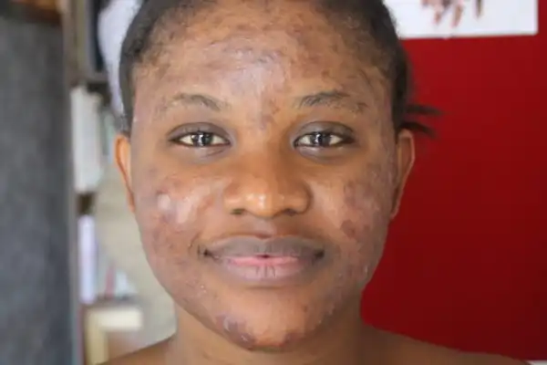 15 Best/Easy Home Remedies For Treating Pimples