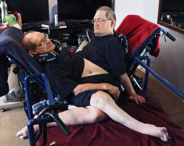 Beautiful Story Of The World’s Oldest Living Conjoined Twins Who Refuse to Be Separated Even at 66