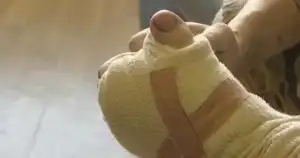 Video: Mans Thumb Replaced with his Toe