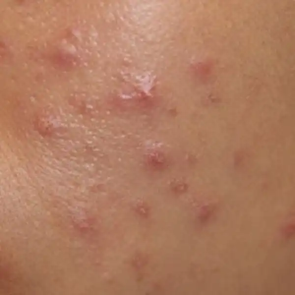 10 Instant Natural Treatments For Pimples