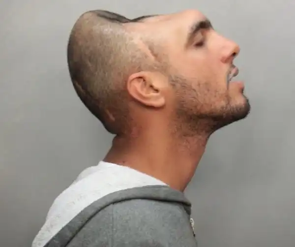 Meet The Man With Half a Head (Photos)