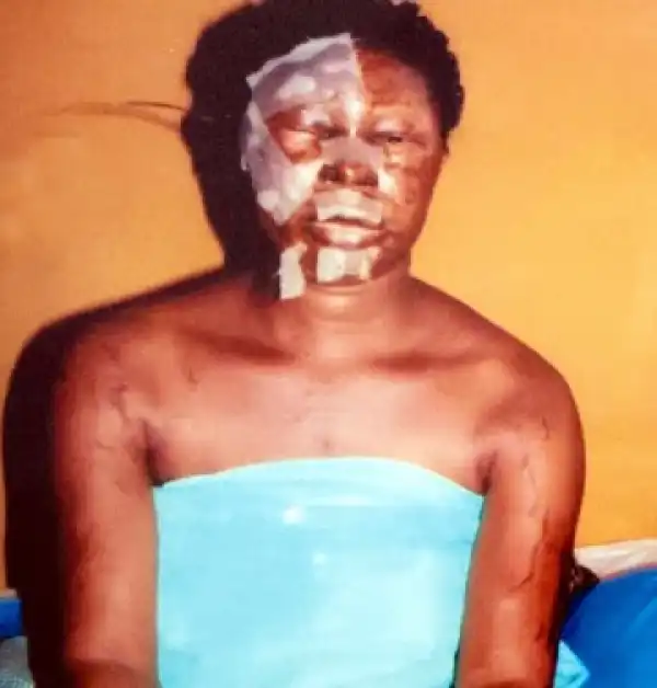 Photo: Man Sends Thugs To Pour Acid On Ex Wife In Lagos