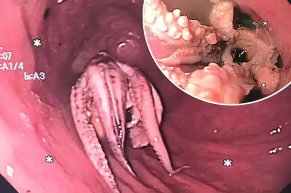 Doctors remove octopus from patient’s throat