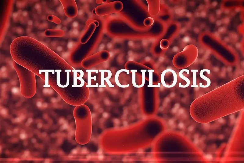 240,000 annual mortality rate: NTS tasks FG, states on eradication of TB