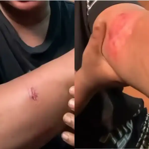 Woman shares bruises she got after allegedly being beaten by her partner (video)