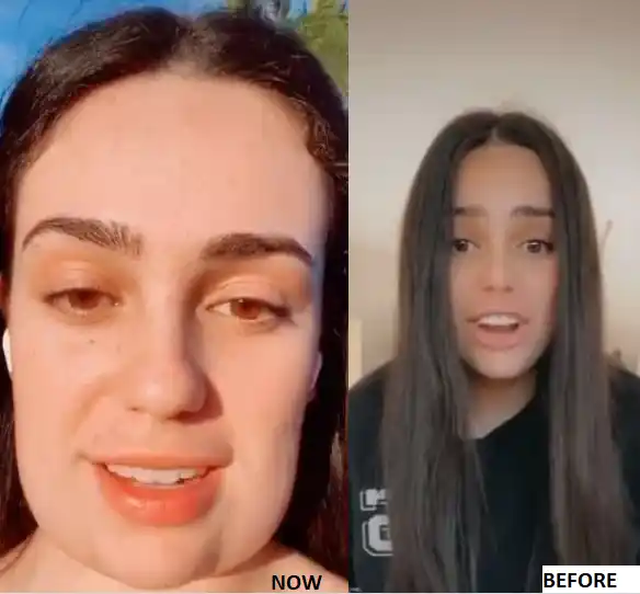 Woman "ends up with square head" after botched chin fat removal surgery