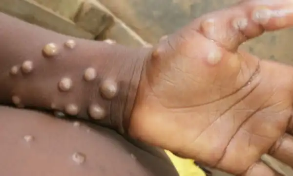 Monkeypox Cases In Nigeria Hits 277 As The Disease Spreads To 30 States