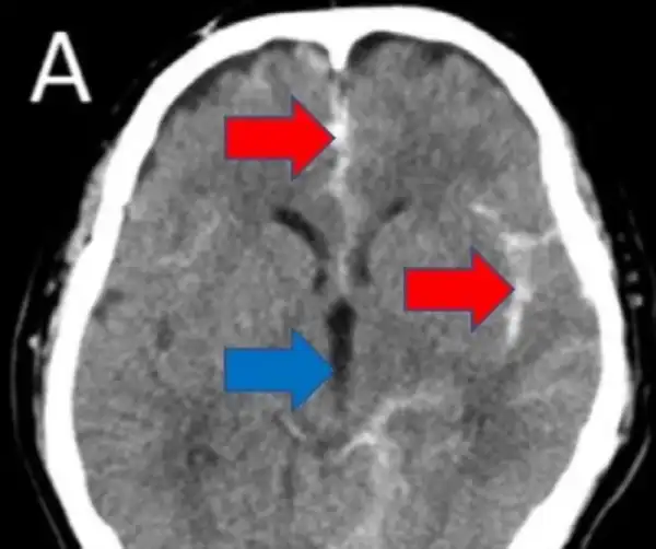 Man almost masturbates himself to death after suffering stroke as a result of the act