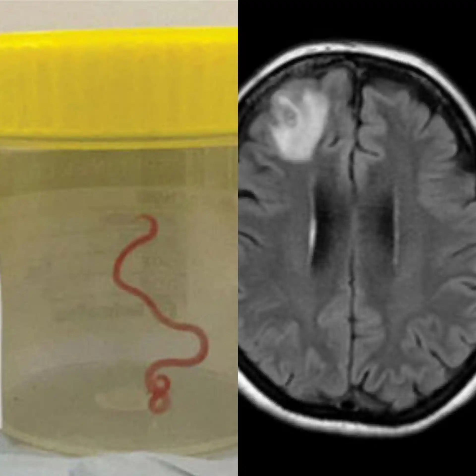 Surgeons find Worm living in woman’s brain in world’s first case after she complained for years of having migraine and pneumonia