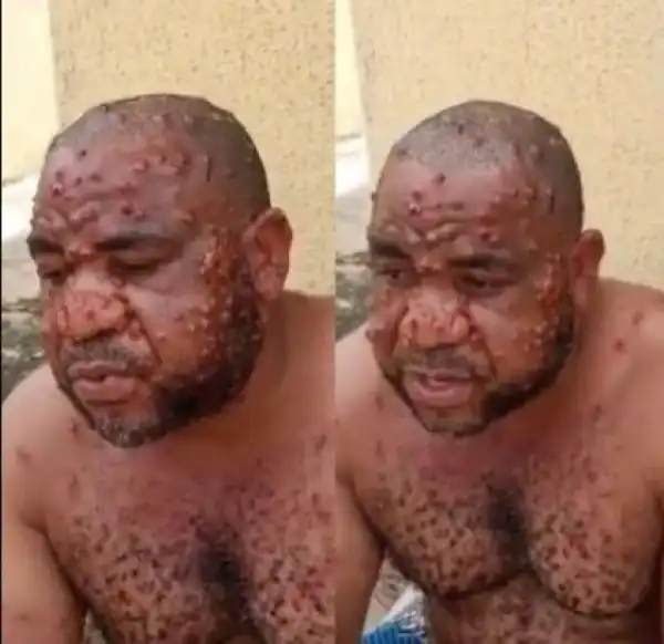 Nigerian Man Suffering From Monkeypox Narrates How He Was Misdiagnosed By Multiple Doctors (Video)